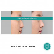 Non-Surgical Nose Job