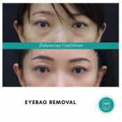 Eye Bag Removal