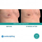 Cellulite Treatment (Breast)