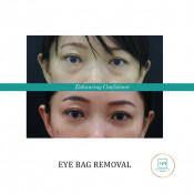 Eye Bag Treatment
