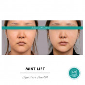 Facelift