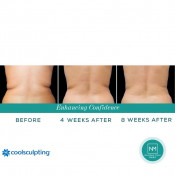 Body Sculpting