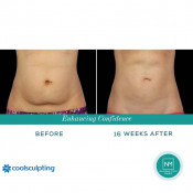 Body Sculpting