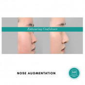 Nose Thread Lift