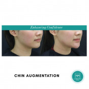 Chin Augmentation