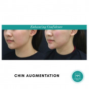 Chin Augmentation