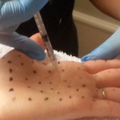 Excessive Sweating (Hyperhidrosis) Treatment