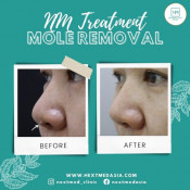 Mole Removal
