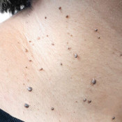 Skin Tag Removal