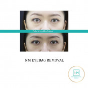 Eye Bag Removal
