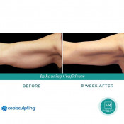 Cellulite Treatment (Arms)