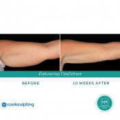 Cellulite Treatment (Arms)