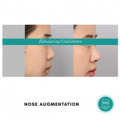 Nose Shape Treatment