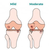 Lubrication Injections