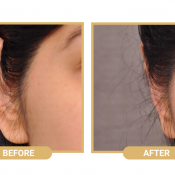 Suture Otoplasty (Non Surgical)