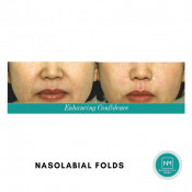 Laugh Lines Treatment