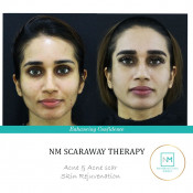 Menghilangkan Bekas Luka