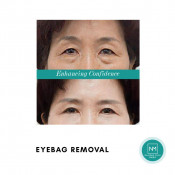 Menghilangkan Kantong Mata