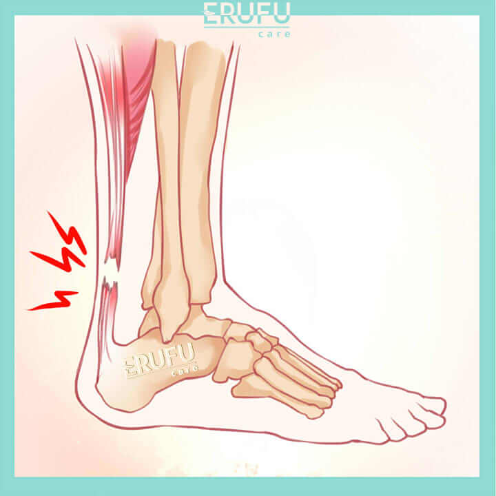 Rawatan Tendon Achilles