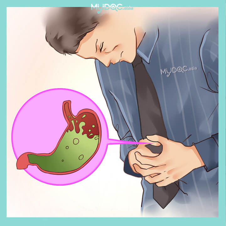Acid Reflux Treatment