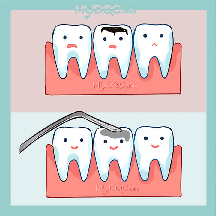 Amalgam Fillings