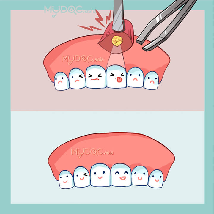 Apicoectomy