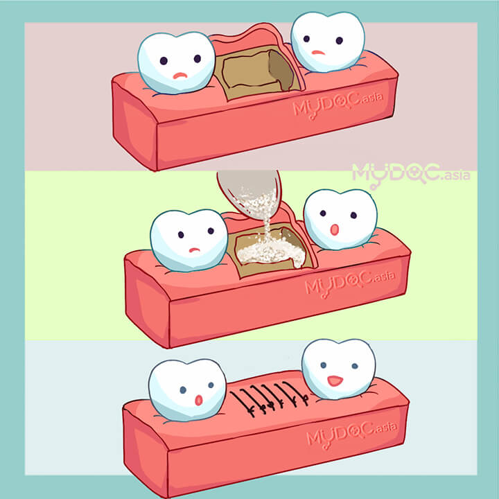 Bone Graft (Dentistry)