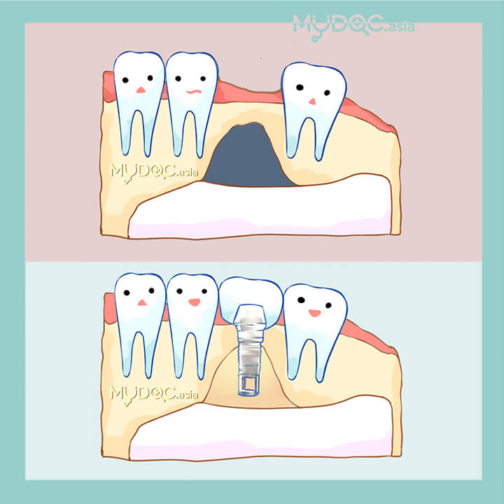 Tulang Keropos dan Pengangkatan Sinus