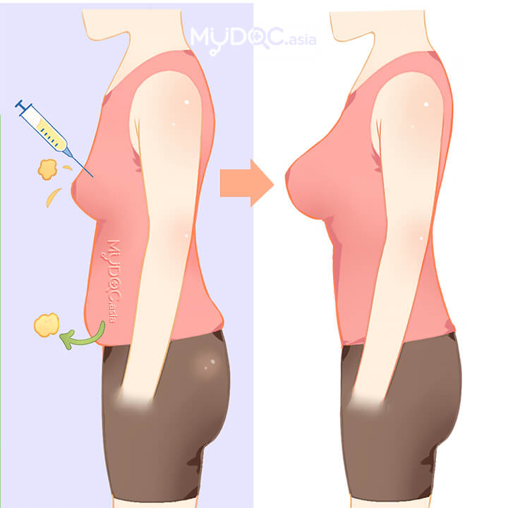 Breast enlargement with fat transfer