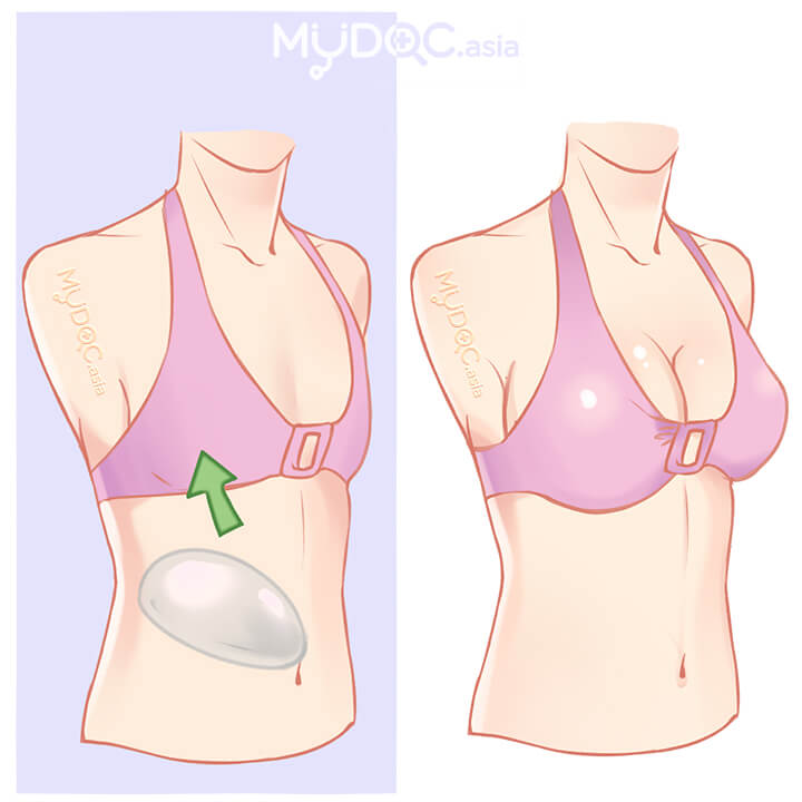 42 Best Breast Implants In Malaysia Price Guide Reviews