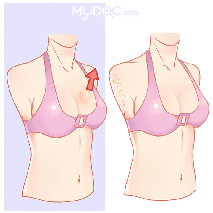 Breast Lump Removal