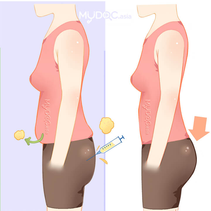 Buttock Firming and Reshaping