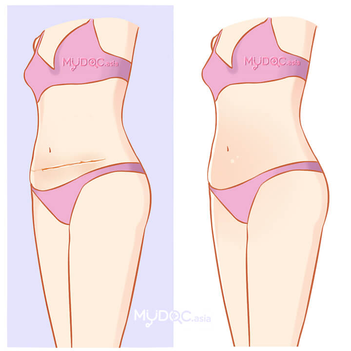 C-section Scar Removal