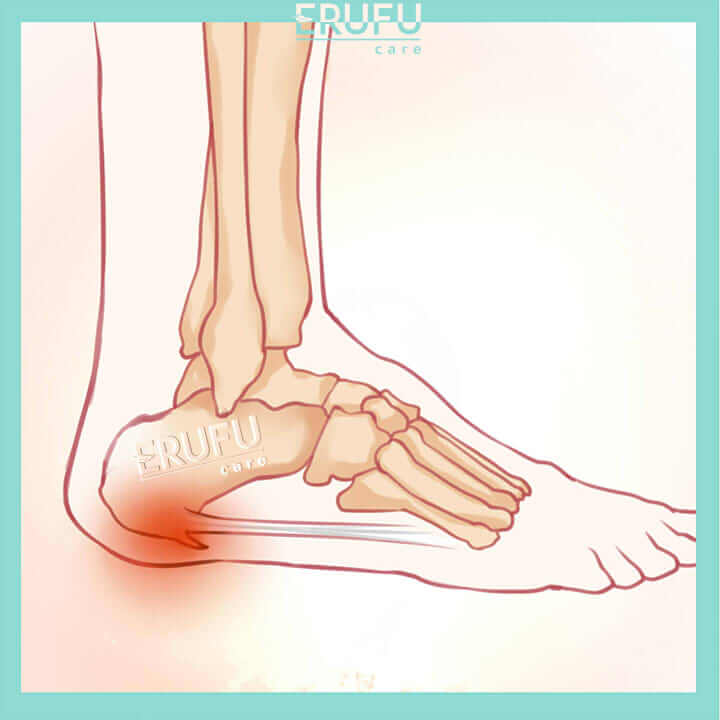 Calcaneal Spurs Treatment