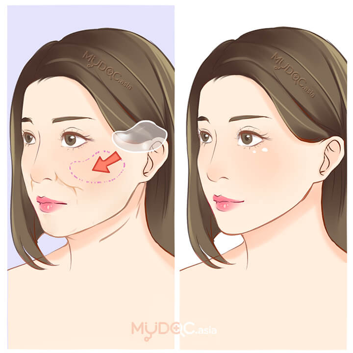 Cheek Implants
