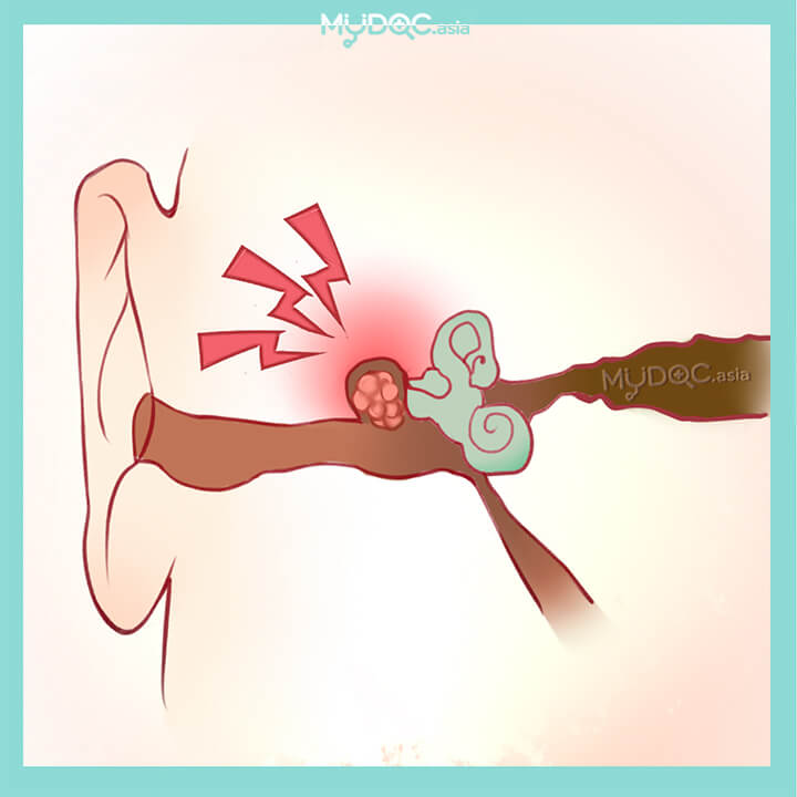 Cholesteatoma Treatment