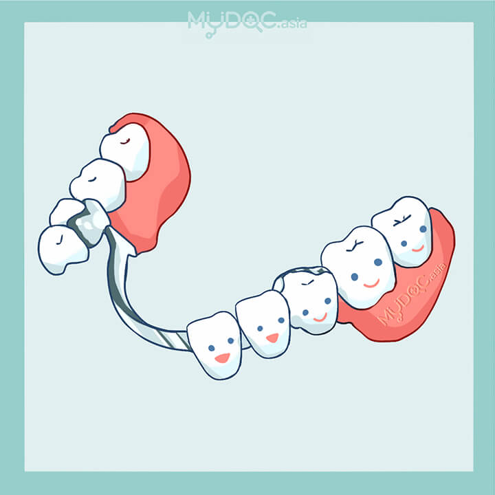 Chrome Dentures