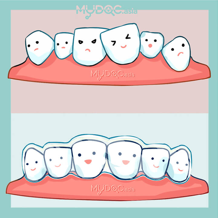 Clear Aligners