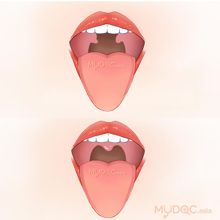 Cleft Palate Surgery