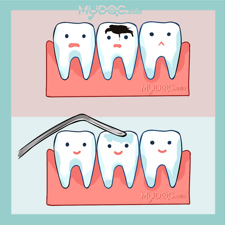 Composite Resin Fillings