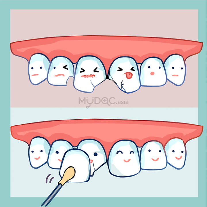 Composite Veneer