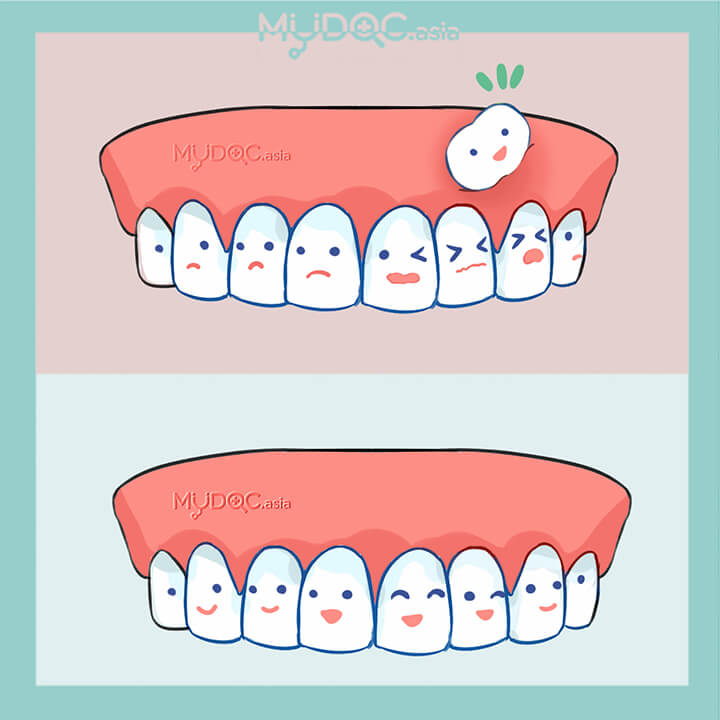 Dental Abscess Treatment for Paediatric