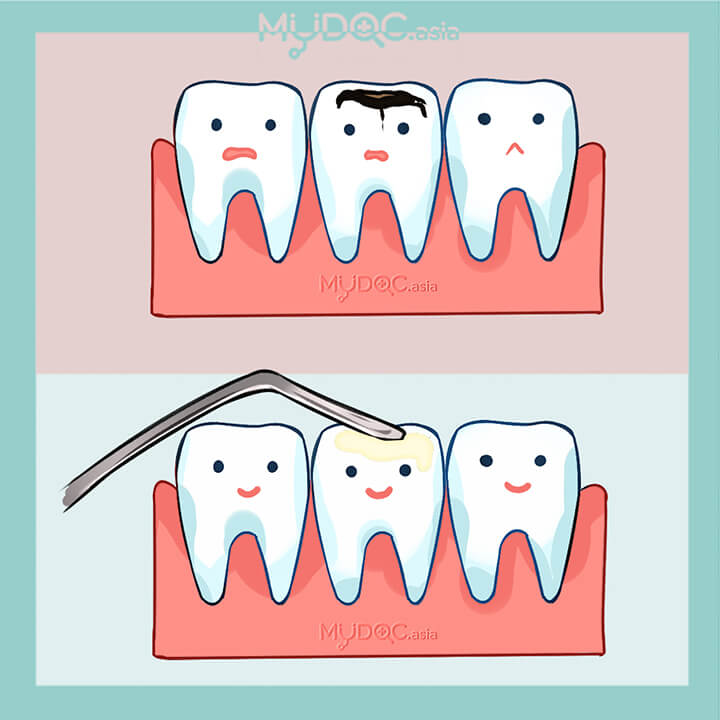 Dental Sealants