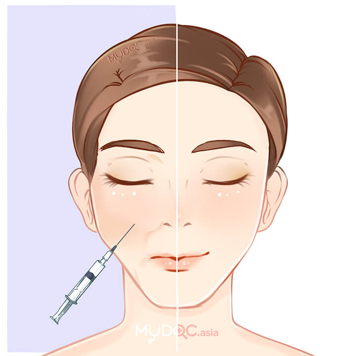 Dermal Fillers