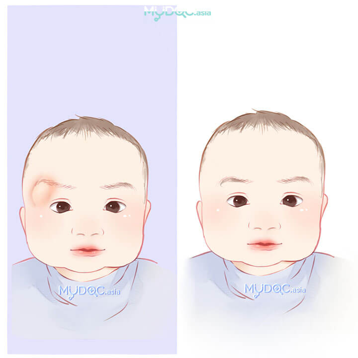 Dermoid Cyst Surgery