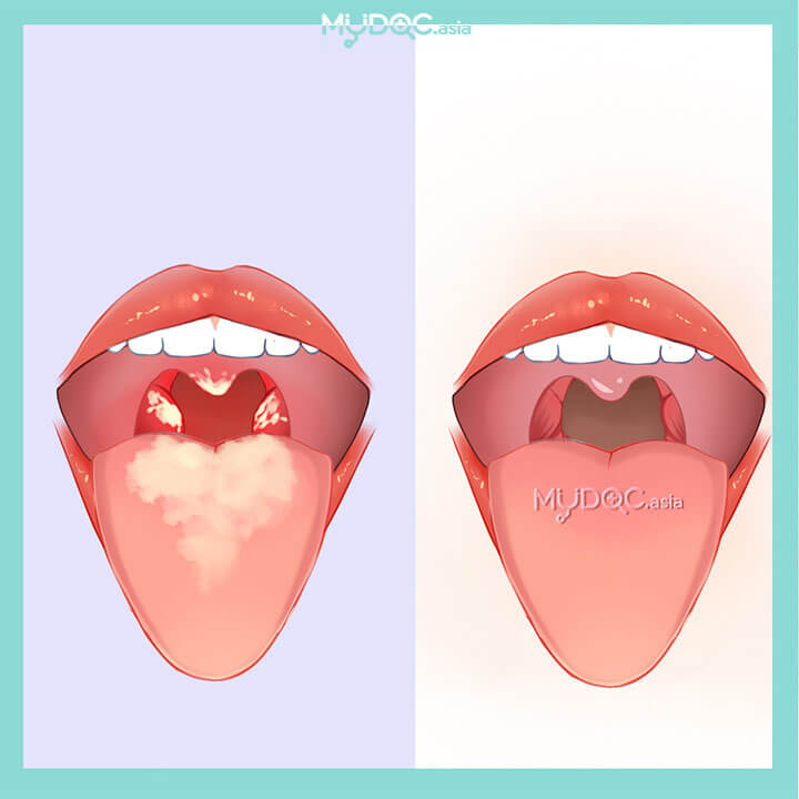 Diphtheria Treatment