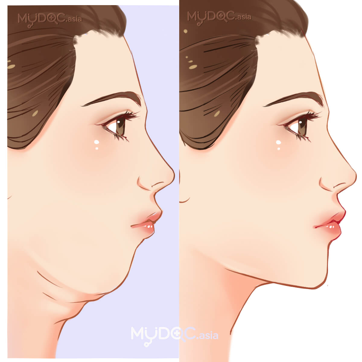Double Chin Treatment