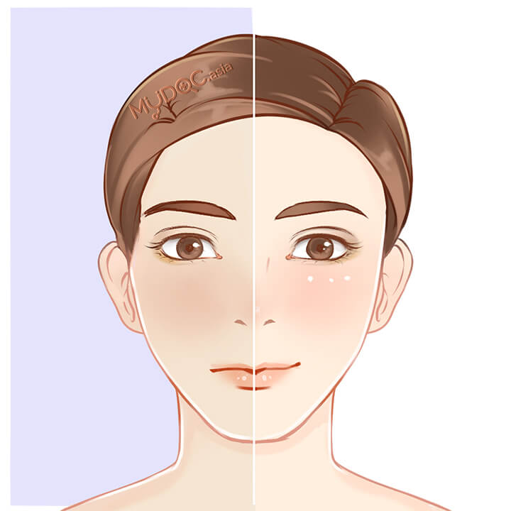 Dull Skin Treatment
