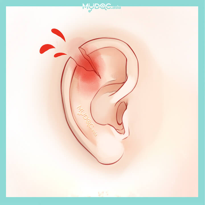 Ear Injury (Ear Trauma) Treatment