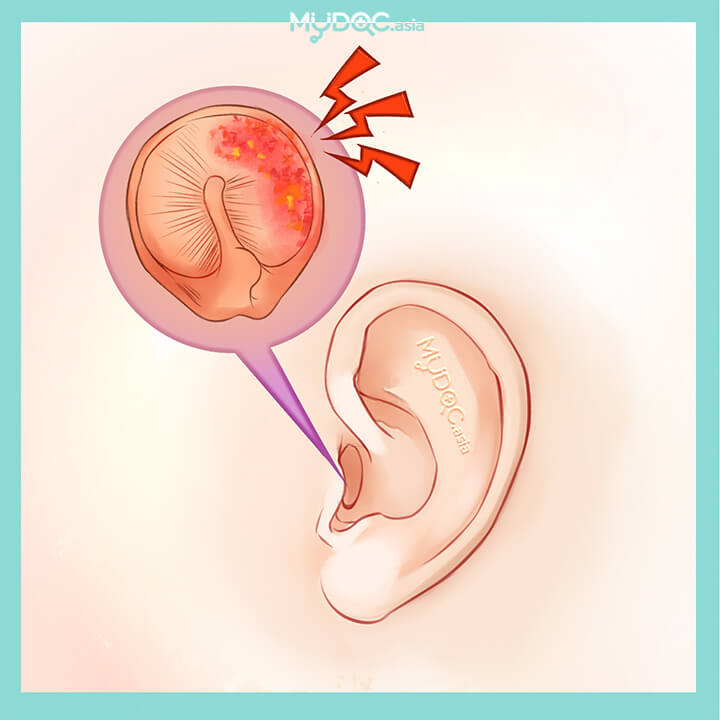 Eardrum Infection Treatment